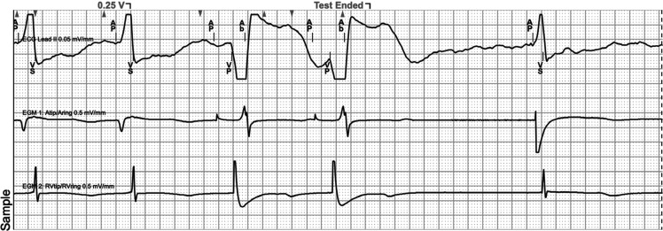 A Novel Technique for Conduction System Pacing in Patients Undergoing Simultaneous Ablation of the Atrioventricular Node Using Axillary Venous Access.