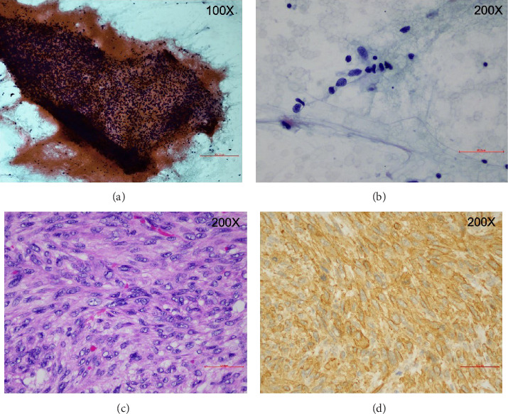 Thyroid Fibrosarcoma as a Rare Differential Diagnosis of Anaplastic Thyroid Cancer: A Case Report.