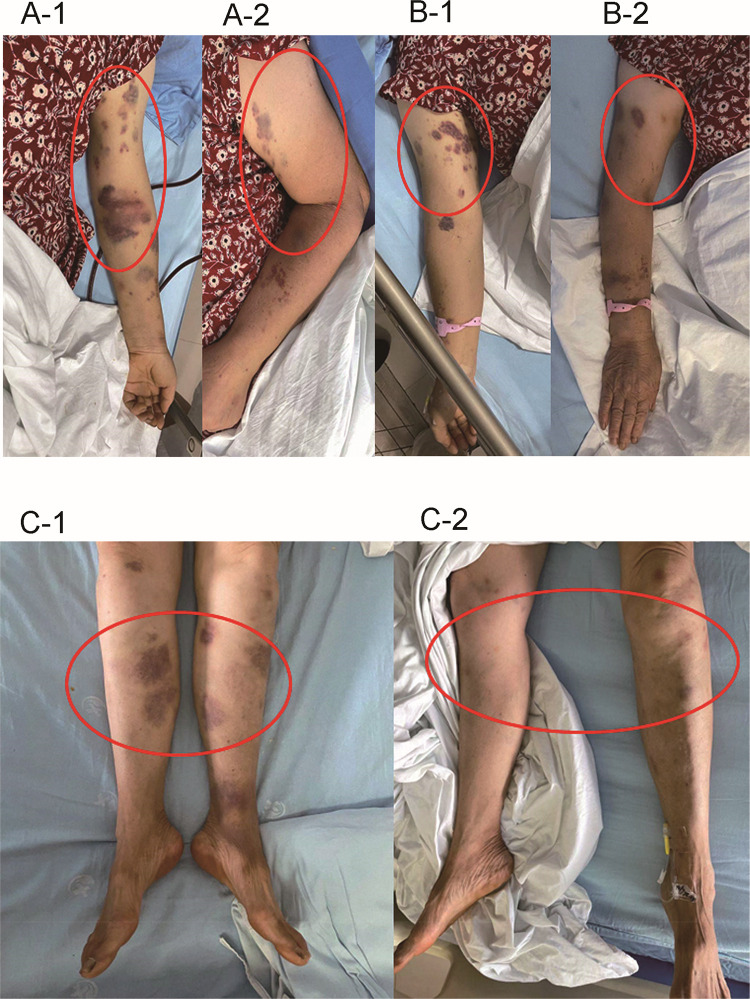Reversible Toxic-Metabolic Encephalopathy in Fluroacetamide Intoxication: A Case Report and Review of the Literature.