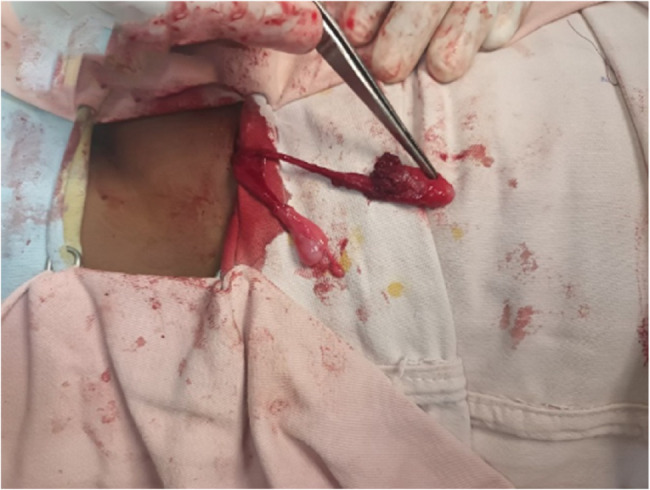 Ipsilateral polyorchidism with cryptorchidism in a pediatric patient: a rare case report from a resource-limited setting.