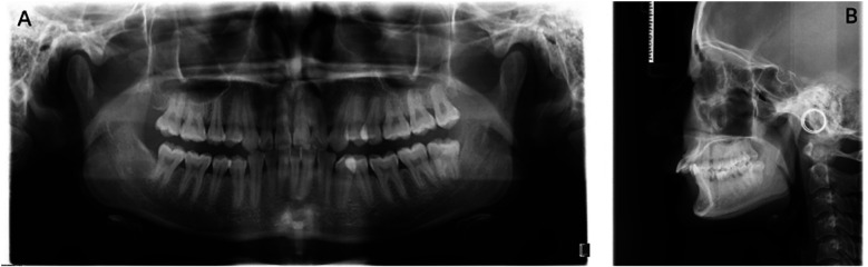 Rescuing a "hopeless" tooth with severe internal resorption during orthodontic therapy: a case report.