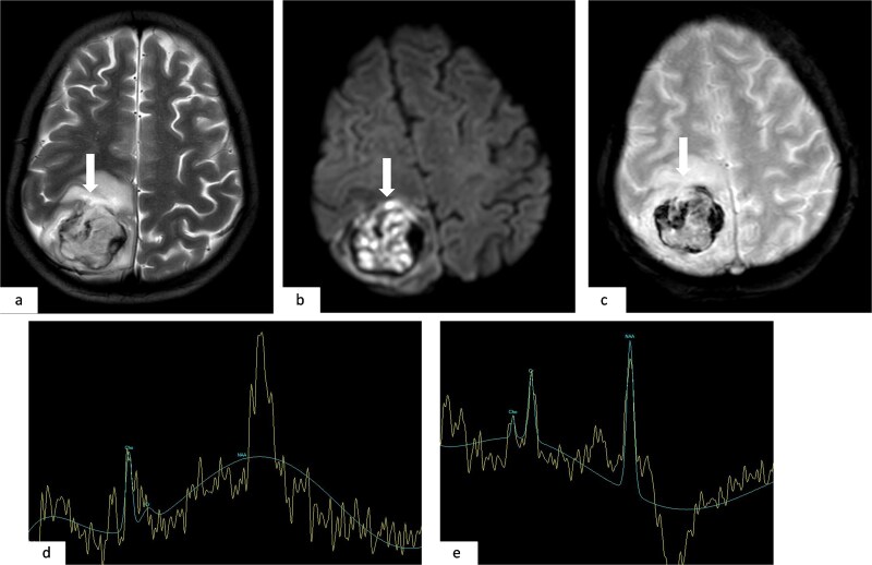 Hemorrhagic brain metastasis as the initial presentation of osteosarcoma: a rare case report.