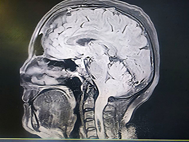 Septic Shock After Surgery in Arnold-Chiari Malformation Type I: A Case Report.