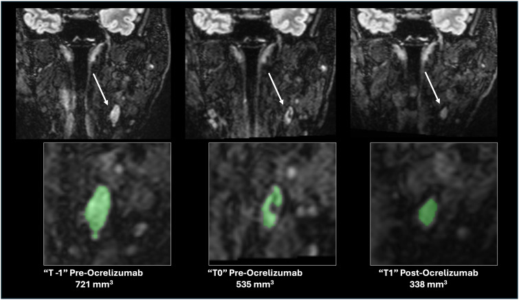 Deep cervical lymph node volume decreases following B-cell depletion therapy.