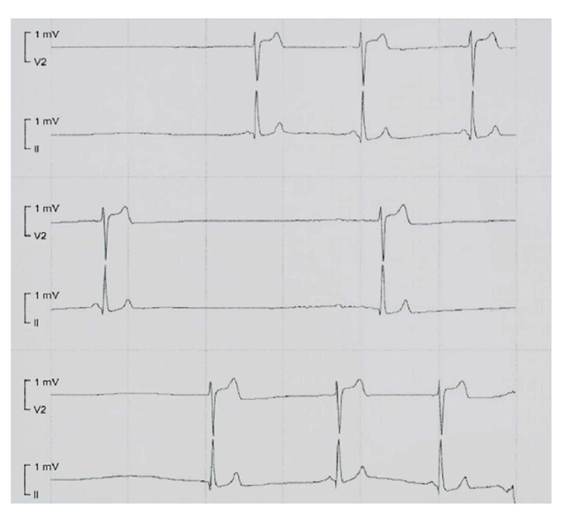 Severe Bradyarrhythmia and Reduced Cardiac Output Due to Oral Baclofen Withdrawal in a 24-Year Old Man: A Case Report.
