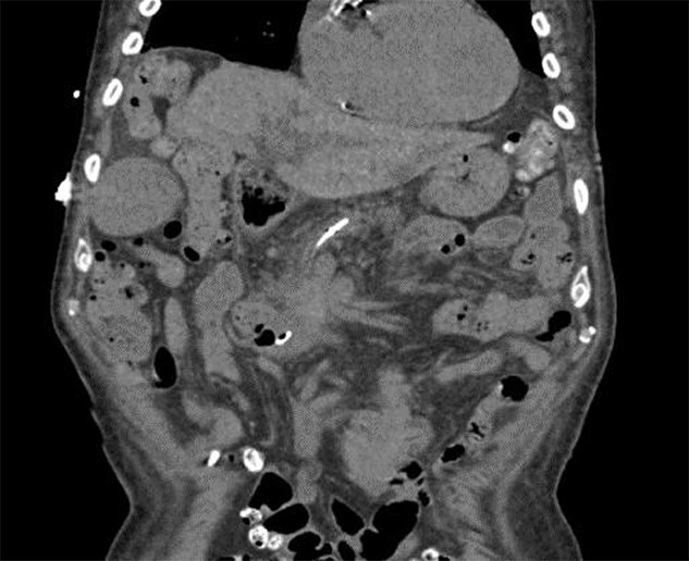 A case of paraneoplastic myositis induced rhabdomyolysis due to pancreatic adenocarcinoma.