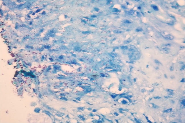 The Balance Between Autoimmunity and Infection: A Case Report of Concomitant Pathology of Pulmonary Nocardia and Granulomatosis with Polyangiitis at Initial Presentation.
