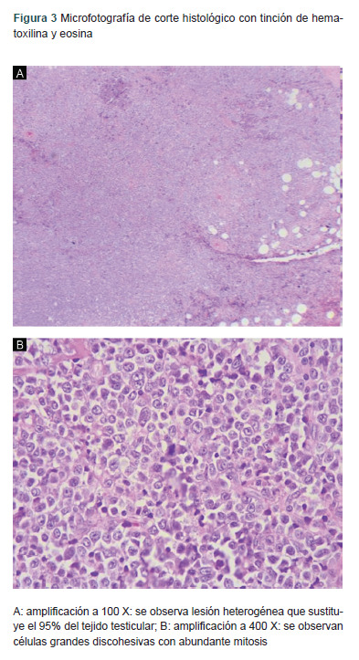 [Primary testicular lymphoma with extranodal involvement in the stomach. Case report].