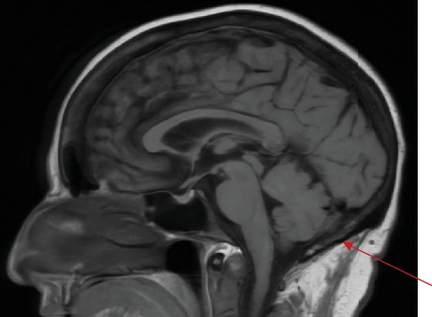 Leptomeningeal Carcinomatosis and Myelophthisic Anemia as Initial Manifestations of Metastatic Lobular Breast Cancer.