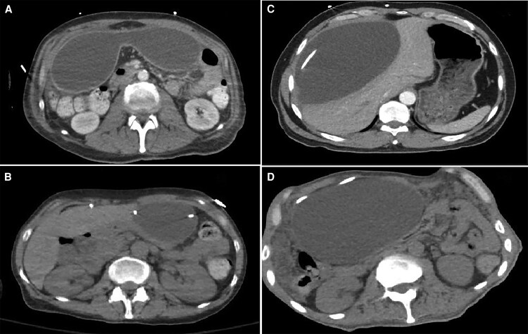 Trapped Below: Abdominal Pseudocysts Associated With Ventriculoperitoneal Shunts in Coccidioidal Meningitis.
