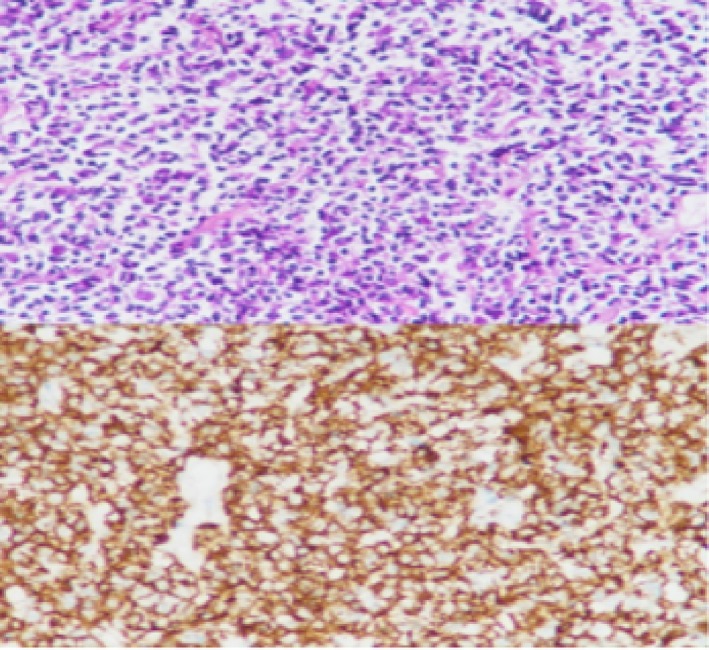 Rare Case Report of Pulmonary Mucosa-Associated Lymphoid Tissue Lymphoma.