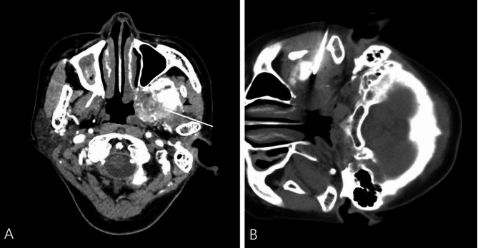 A percutaneous core needle biopsy of deep suprahyoid head and neck lesions with CT-guided: study of diagnostic performance and factors associated with diagnostic failure.