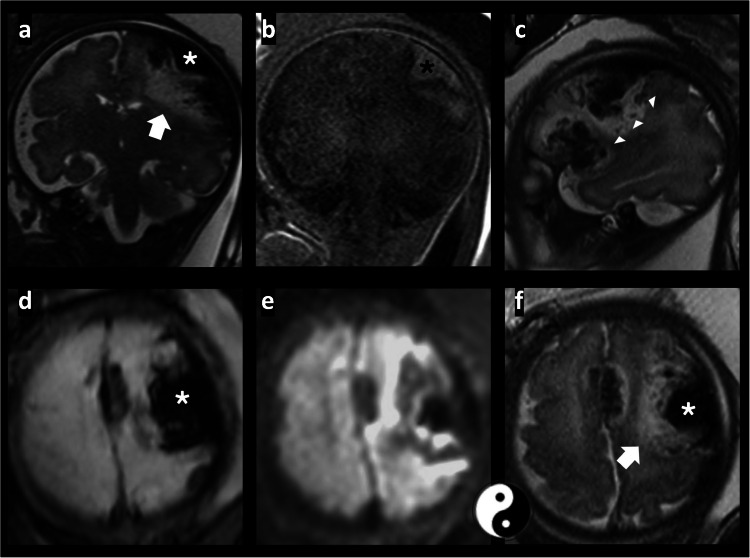 Antenatal subpial hemorrhage diagnosed by fetal magnetic resonance imaging: imaging spectrum and autopsy findings.