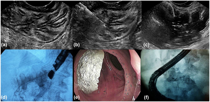 Current status and further directions of endoscopic ultrasound-directed transgastric ERCP and endoscopic ultrasound-directed transenteric ERCP in the management of pancreaticobiliary diseases in surgically altered anatomy: a comprehensive review.