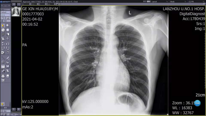 Delayed diagnosis of aortic dissection: the overlooked clues on chest X-ray.