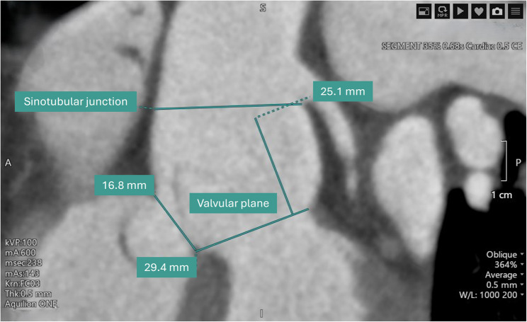 Multimodal imaging in young male with bicuspid aortic valve, right-sided aorto-atrial fistula and single coronary artery.