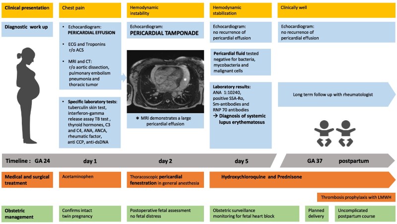 Pericardial tamponade in pregnancy due to undiagnosed systemic lupus erythematosus: a case report.
