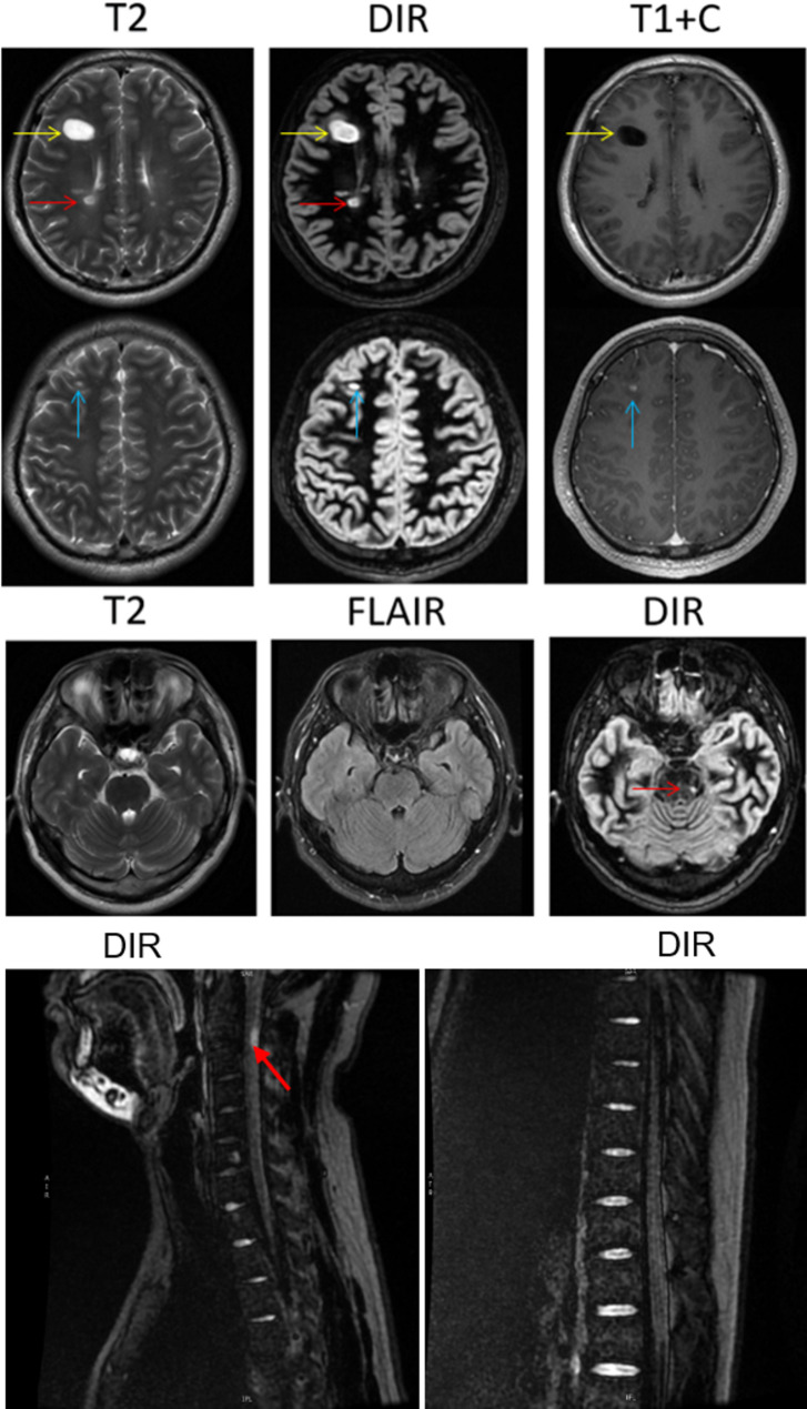Use of MRI-double inversion recovery sequence for early diagnosis of multiple sclerosis: case series.