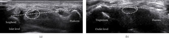 Evaluating Various Ultrasound Criteria for Determining Carpal Tunnel Syndrome Severity.