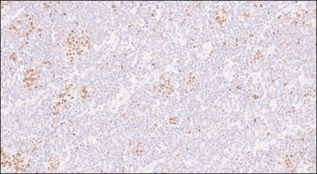 Adult-Onset Pancreatoblastoma.