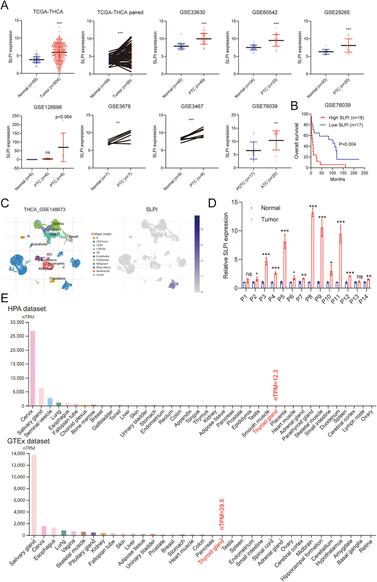 SLPI as a dedifferentiation biomarker in BRAFV600E-mutant papillary thyroid cancer.