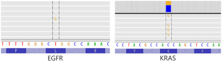 Dual EGFR L858R and KRAS G12A Mutations in Lung Adenocarcinoma: A Rare Case Report and Literature Review.