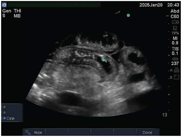 Pneumatosis Intestinalis Detected by Point of Care Ultrasound, Case Report.