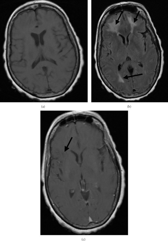 Presumed Cerebral Vasculitis Following Pneumococcal Meningitis: A Rare but Life-Threatening Complication.