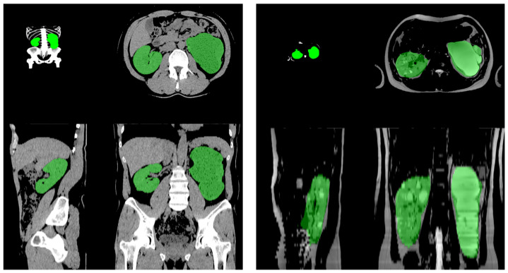 Comparison Between the Human-Sourced Ellipsoid Method and Kidney Volumetry Using Artificial Intelligence in Polycystic Kidney Disease.