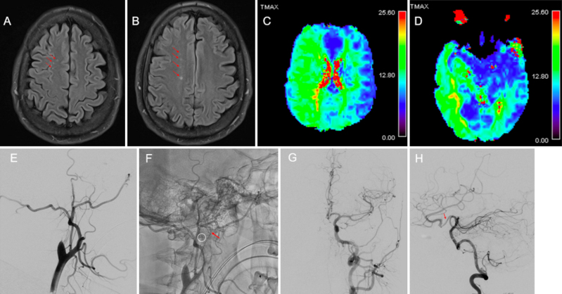 Cranial bypass for occlusive carotid dissection in osteogenesis imperfecta: illustrative case.