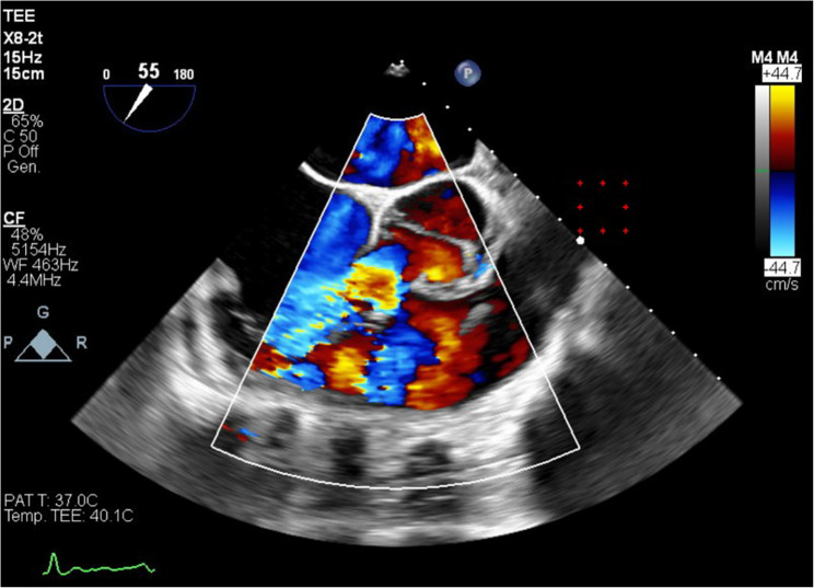 Multimodal imaging in young male with bicuspid aortic valve, right-sided aorto-atrial fistula and single coronary artery.