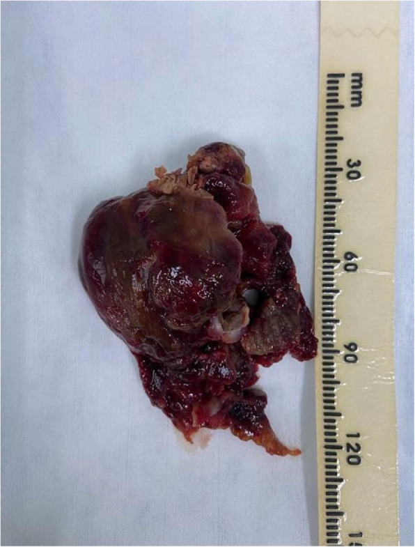 Giant right atrial myxoma emerging from the suprahepatic inferior vena cava, extending to the right atrium; a case report and literature review.