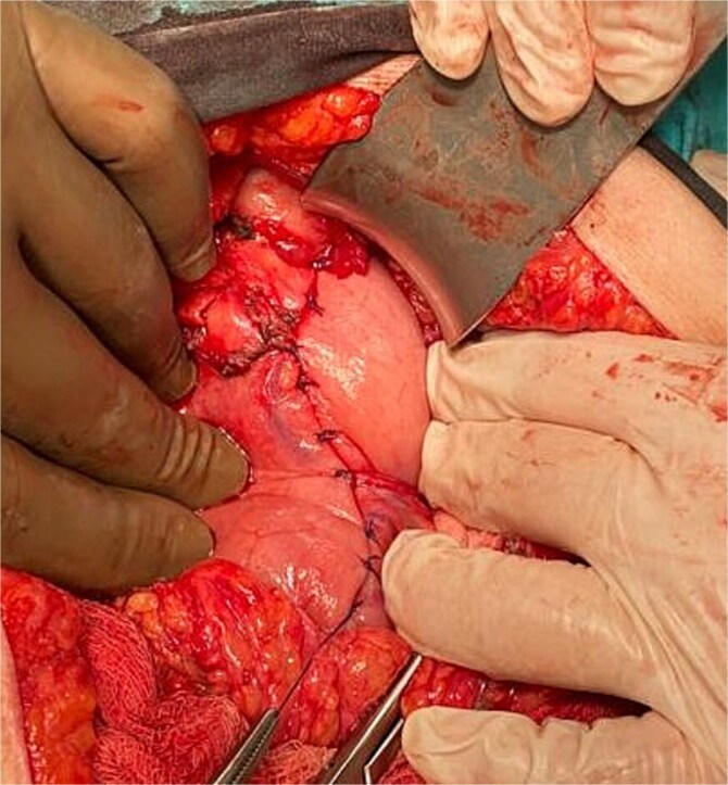 Alternative approach of complicated peptic ulcer perforation in recurrent and delayed-two cases.