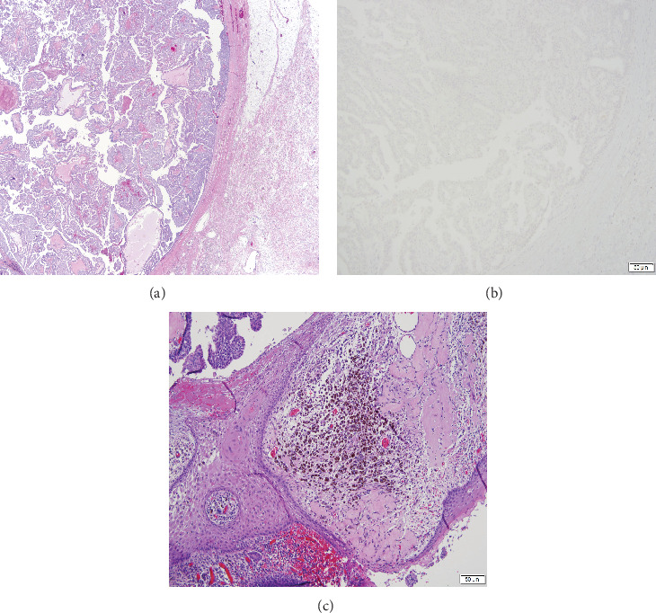 An Advanced-Stage Encapsulated Papillary Breast Carcinoma in a Male: A Case Report.