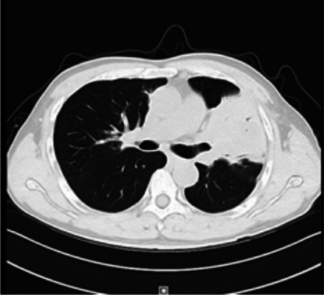 Rare Case Report of Pulmonary Mucosa-Associated Lymphoid Tissue Lymphoma.