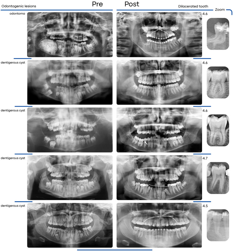 Influence of odontogenic lesions on root development in impacted teeth: a cohort study.