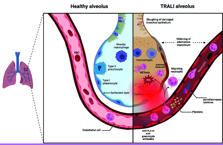 Transfusion-related acute lung injury (TRALI): Current understanding, challenges, and future directions.