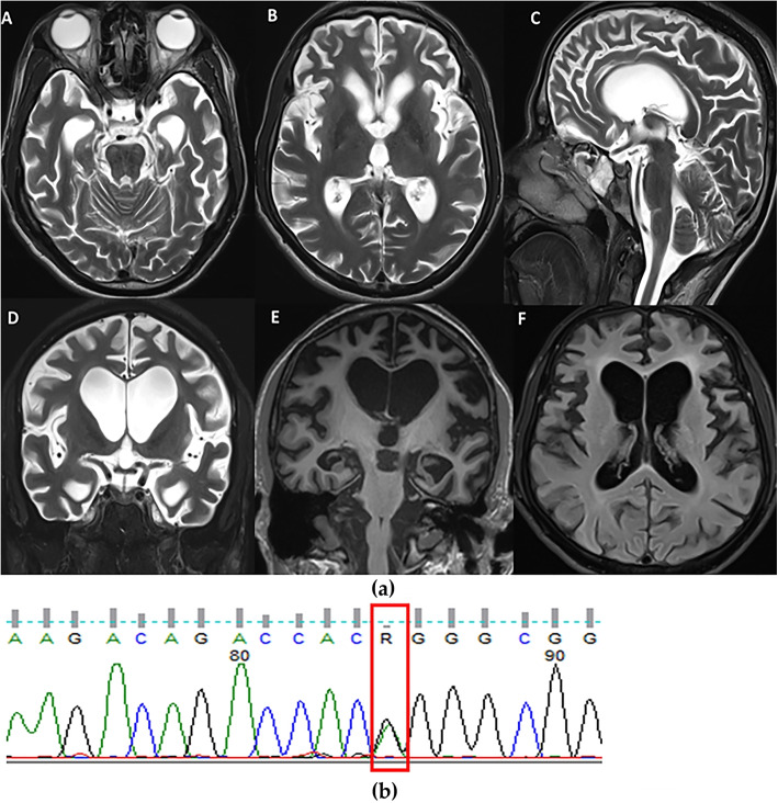 Clinical profile, atrophy and inheritance patterns of pathogenic MAPT gene mutations in Frontotemporal dementia detected using whole exome sequencing: a single-center first report from India.