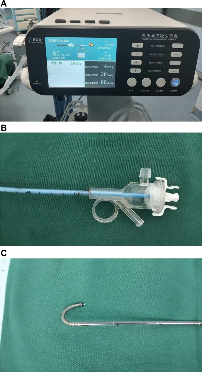 Retrograde intrarenal surgery with intelligent pressure control: experience from a primary hospital in China.