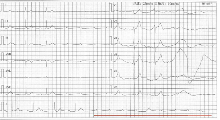 Delayed recurrence of complete atrioventricular block following ablation for premature ventricular complexes.
