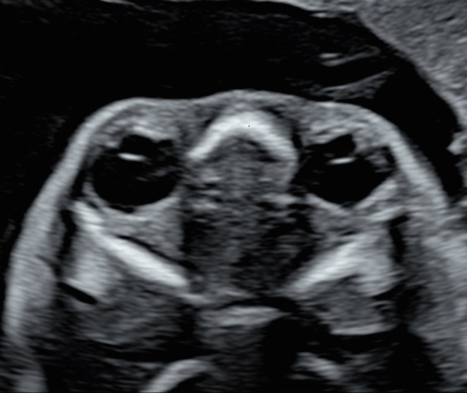 Prenatal Ultrasound Diagnosis and Prognosis Analysis of Fetal Congenital Cataract.