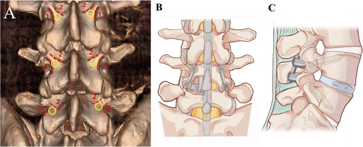 Comparative study of modified midline lumbar interbody fusion and modified transforaminal lumbar interbody fusion for the treatment of single-level lumbar degenerative diseases.