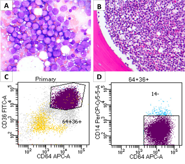 Lineage Switch of Adult B-Cell Acute Lymphoblastic Leukaemia to Acute Myeloid Leukaemia Following B-Cell-Directed Therapy.