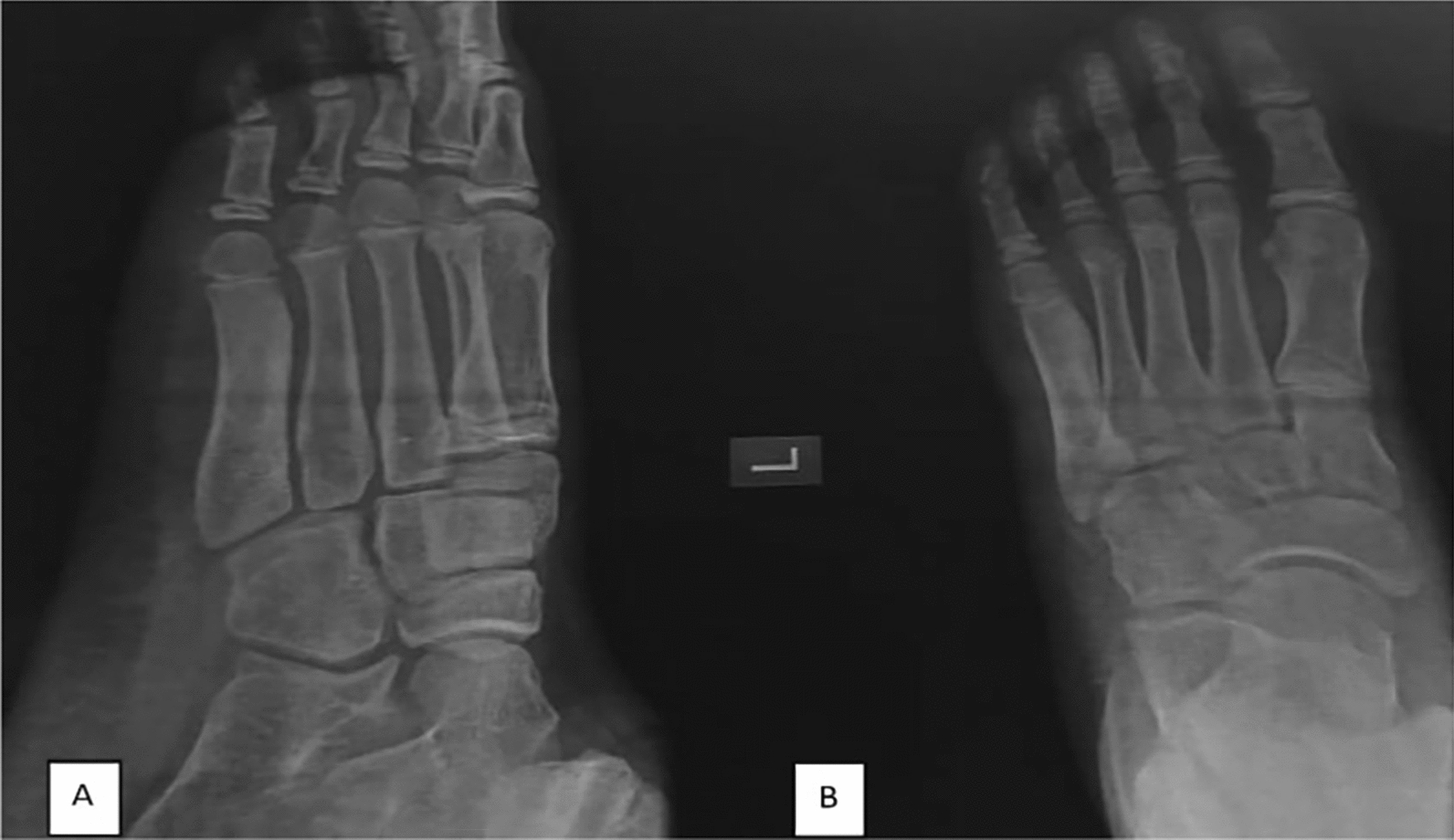 Presentation of osteoid osteoma in the fifth metatarsal: a case report and review of the literature.