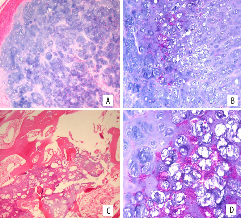 Diagnosis and Management of Large Extraosseous Myxoid Chondrosarcoma of the Buttocks: A Case Report.