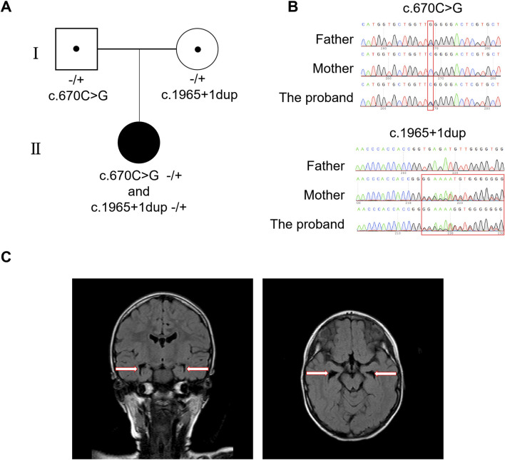 Unraveling the pathogenicity role of the novel compound heterozygous mutations of MED25 gene in a Chinese patient with BVSYS.