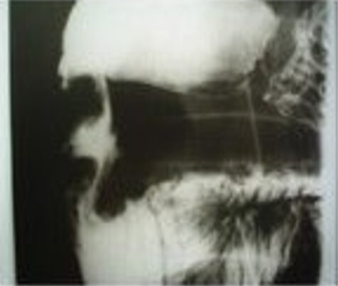 Pancreatoduodenectomy and surgical treatment of groove pancreatitis.