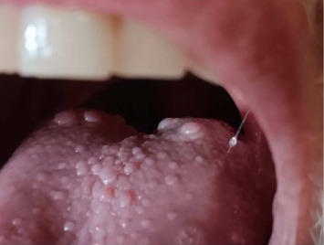 Linezolid-Induced Glossitis and Papillitis in Orthopedic Patients With Postoperative Infection: A Case Report.