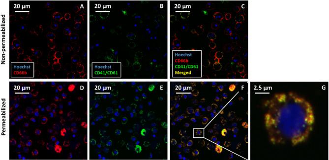 Neutrophil expression of CD41/CD61 complex contributes to their adhesiveness in both healthy individuals and heart failure patients.