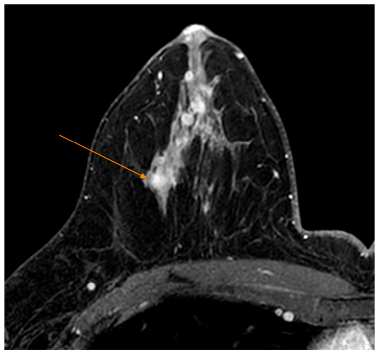 Therapeutic Patterns and Surgical Decision-Making in Breast Cancer: A Retrospective Regional Cohort Study in Romania.